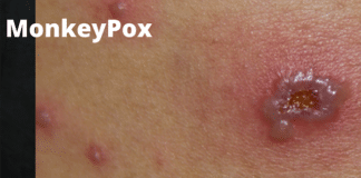 moneypox